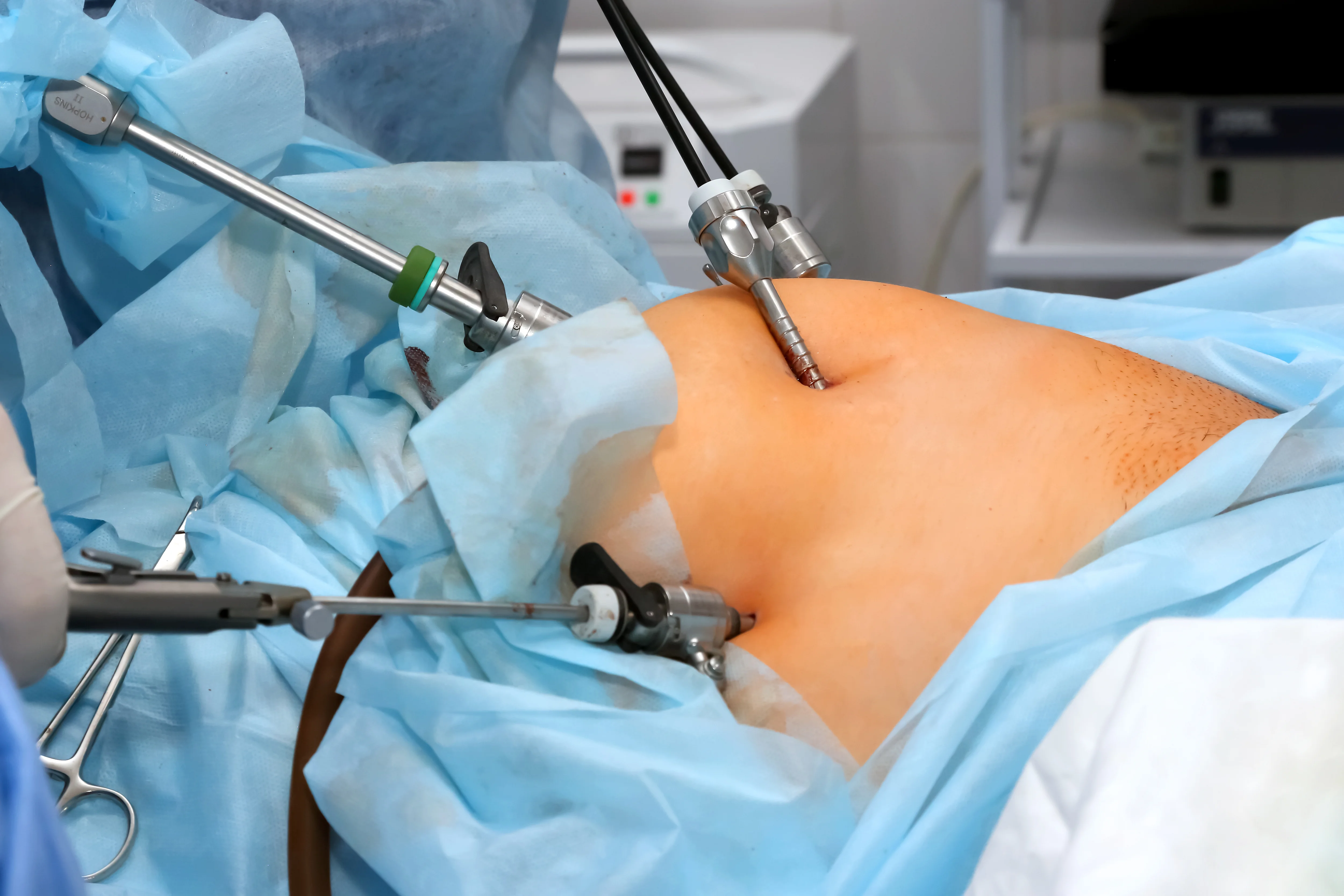 Laparoscopic surgery in progress